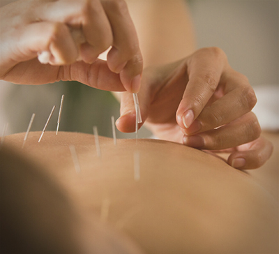 Женщина на сеансе иглоукалывания